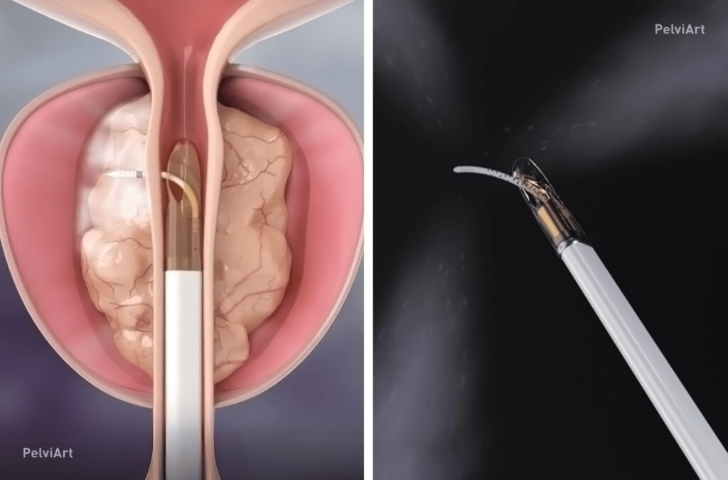 Terapia de vapor de agua para la próstata