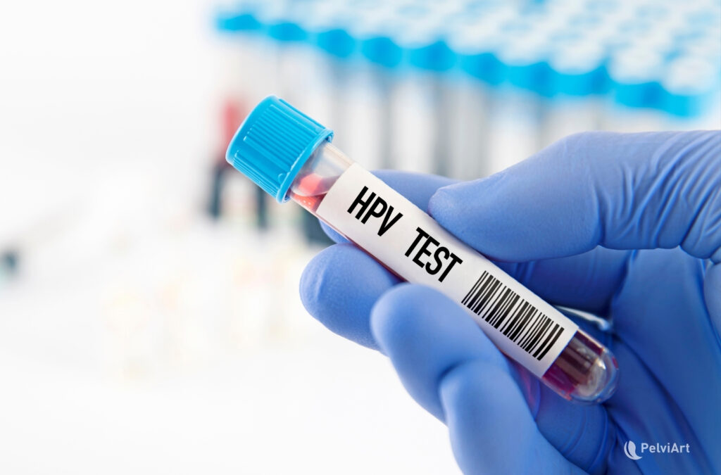 Muestra de laboratorio rotulada como “HPV Test”, utilizada para la detección del Virus del Papiloma Humano en hombres